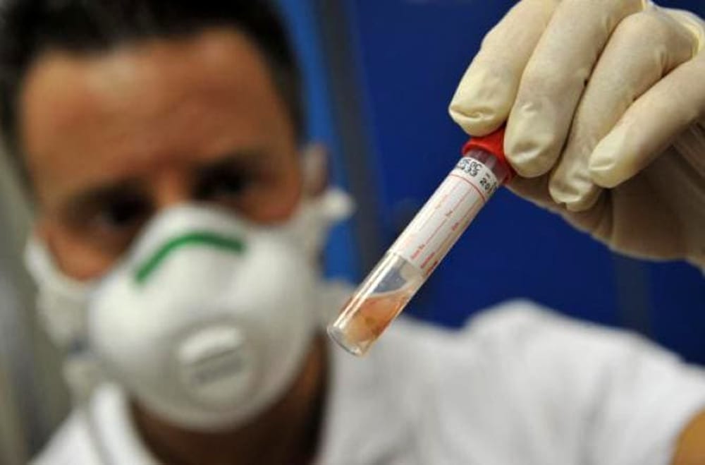 Casi di tubercolosi a Carugate, cinquanta persone in profilassi
