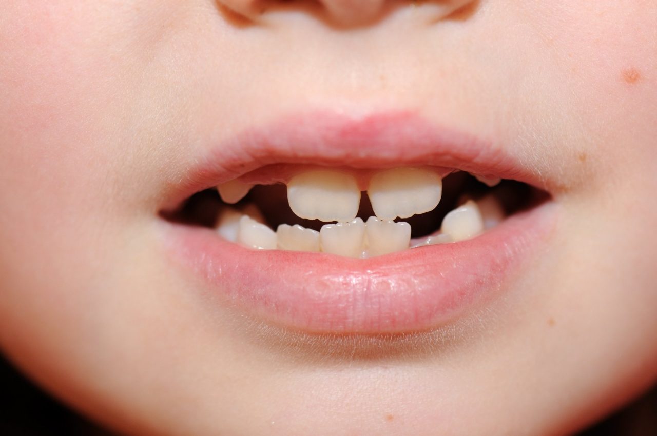 Ortodonzia infantile e prevenzione dentaria: cosa è importante sapere