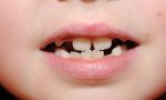 Ortodonzia infantile e prevenzione dentaria: cosa è importante sapere