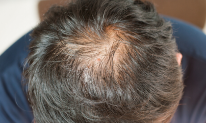 Centro Medico Polispecialistico: perché si perdono i capelli e come si effettua il trapianto