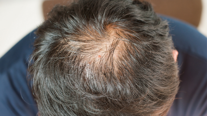 Centro Medico Polispecialistico: perché si perdono i capelli e come si effettua il trapianto