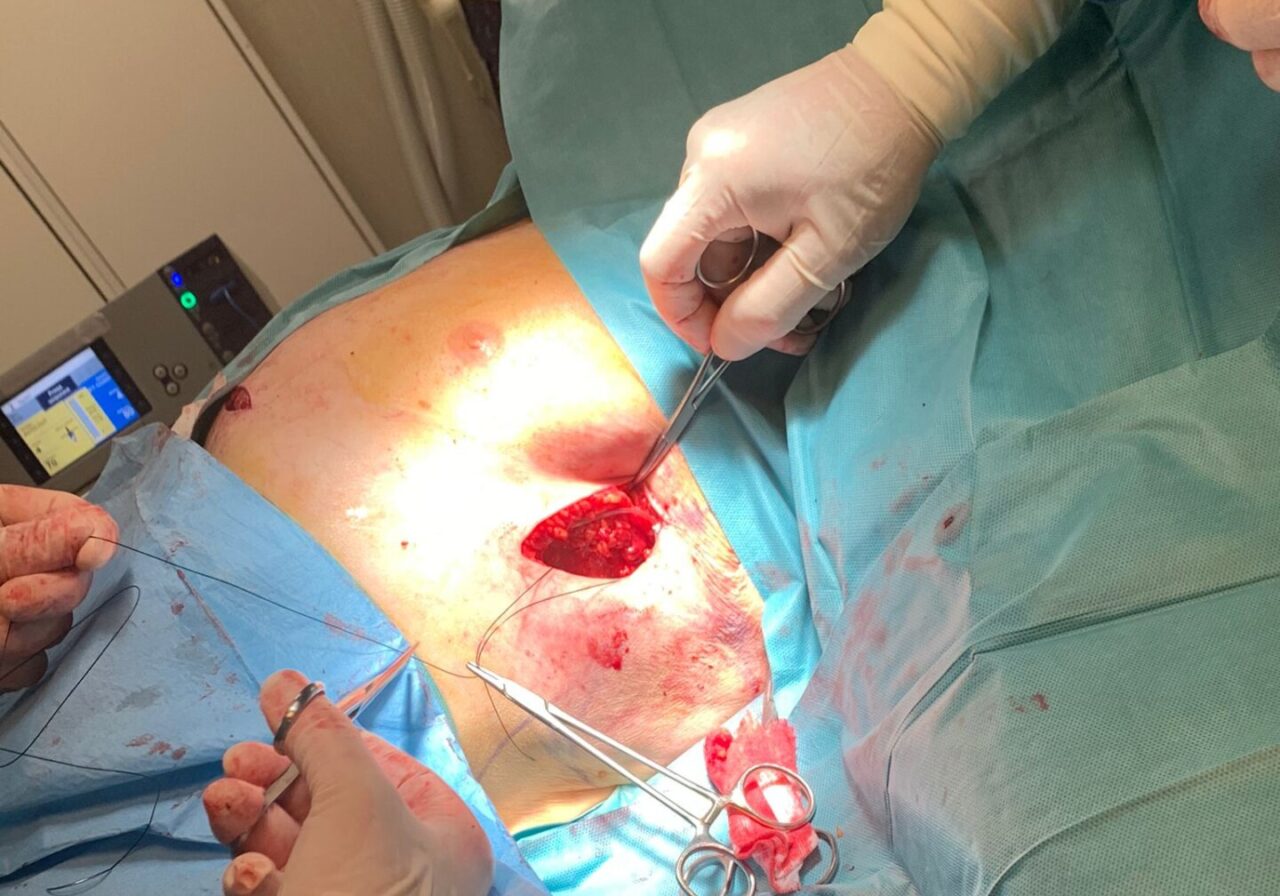 Doppio intervento storico all’Asst Melegnano e Martesana. Per la prima volta impiantato un defibrillatore sottocutaneo
