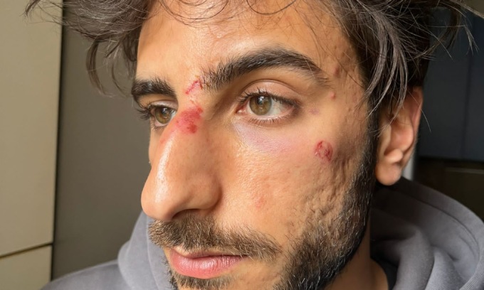 Aggredito a Liscate dopo una partita: “Mi hanno aspettato fuori e rotto il naso”