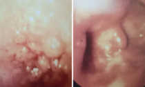 Tubercolosi in Martesana, un caso diagnosticato dal personale della Gastroenterologia di Cernusco sul Naviglio