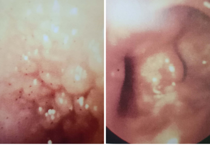 Tubercolosi in Martesana, un caso diagnosticato dal personale della Gastroenterologia di Cernusco sul Naviglio