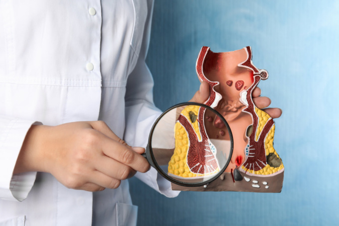 Problemi di emorroidi: cosa sono, quali sono le cause, diagnosi, terapie e stili di vita
