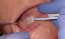 L’Irccs Ospedale San Raffaele scommette sulla diagnosi precoce dei tumori del cavo orale