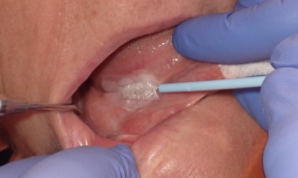 L’Irccs Ospedale San Raffaele scommette sulla diagnosi precoce dei tumori del cavo orale