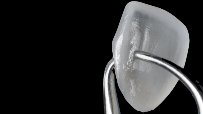 Con le faccette dentali il sorriso che avevi sempre sognato: il 25 novembre giornata dedicata agli Studi Mezzena