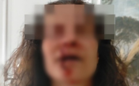 Sfregiò la vicina di casa con una tazzina: chiesti 5 anni di carcere