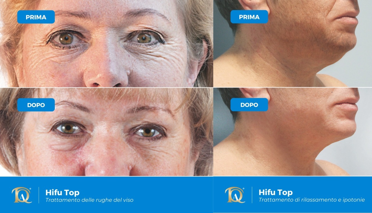 La dottoressa Paola Cacciabue presenta l’innovativa tecnologia  HIFU a ultrasuoni