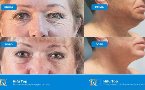 La dottoressa Paola Cacciabue presenta l’innovativa tecnologia  HIFU a ultrasuoni