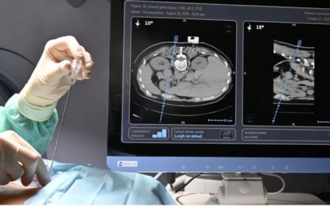 Interventi di estrema precisione: un nuovo capitolo per la Radiologia Interventistica dell’Asst Melegnano Martesana